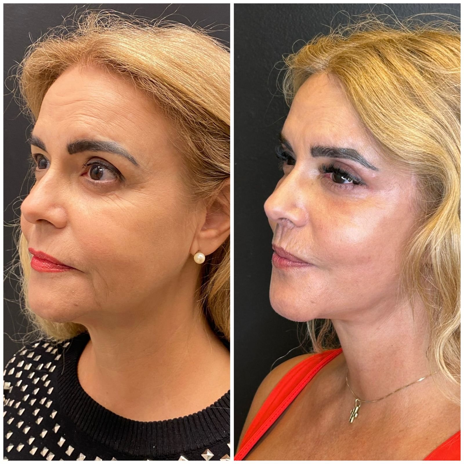 Resultado Paciente 1 - Deep Plane